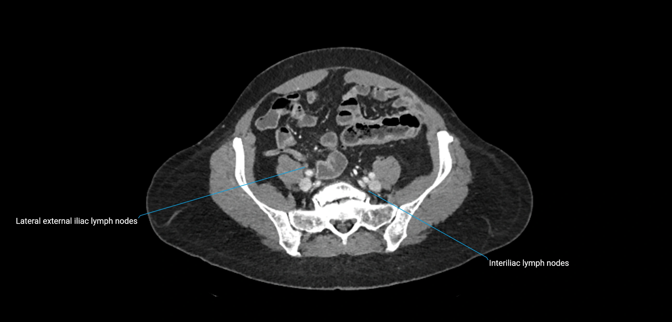CT ct abdominal lymph nodes  axial cross sectional anatomy  enchanced radiology image -img-00002-00315.webp